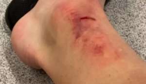 Lateral do Corinthians posta foto de hematomas no tornozelo por causa de dividida