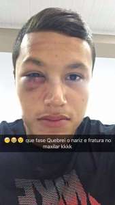 Série B: Marlon, do Criciúma, quebra nariz e fratura maxilar após cotovelada