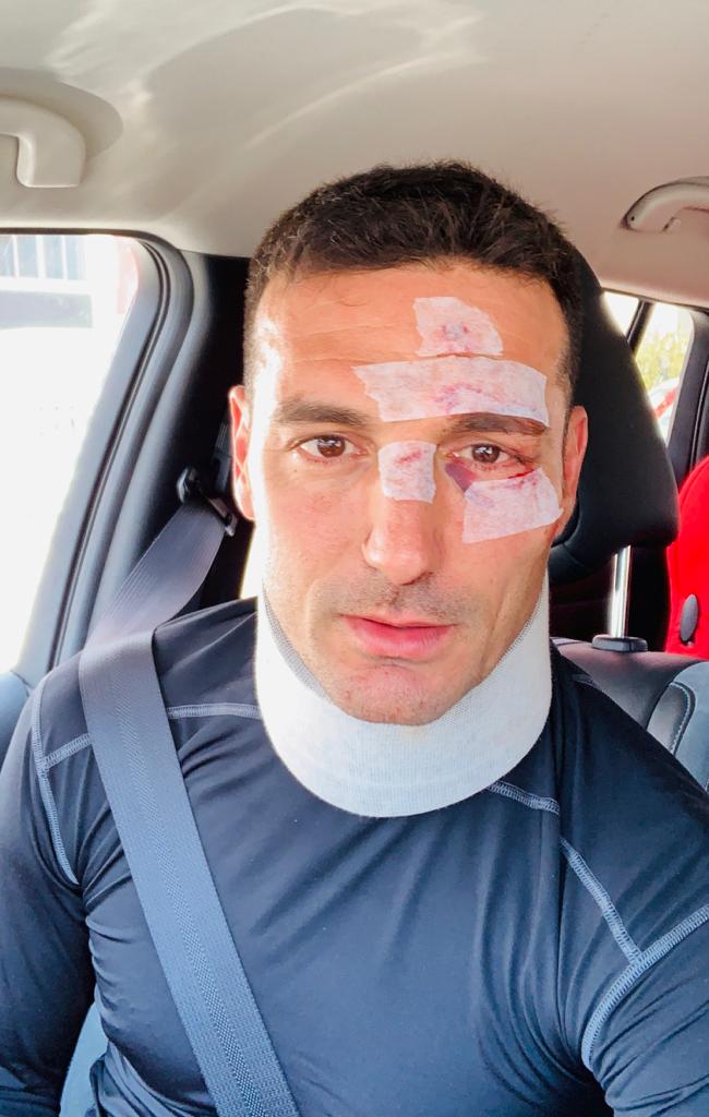 Técnico da Argentina, Scaloni é atropelado na Espanha: ‘Alguns pontos e casa’