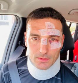 Técnico da Argentina, Scaloni é atropelado na Espanha: 'Alguns pontos e casa'