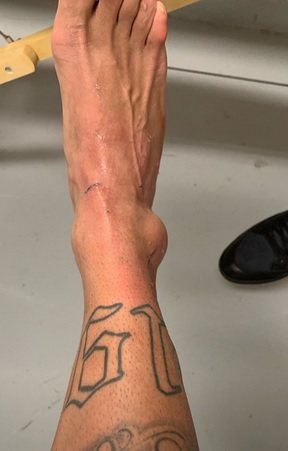 De fora da Copa América, Neymar divulga foto do tornozelo inchado