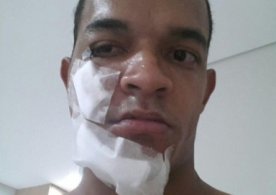 Série B: Jogador do Oeste leva voadora no rosto e vai passar por cirurgia
