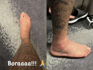 Neymar mostra pé inchado em meio à recuperação de lesão no tornozelo na Copa