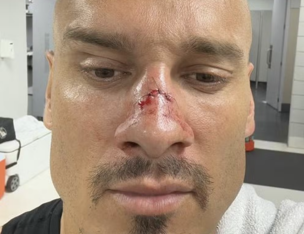 Maicon brinca com pontos no nariz após classificação do Vasco