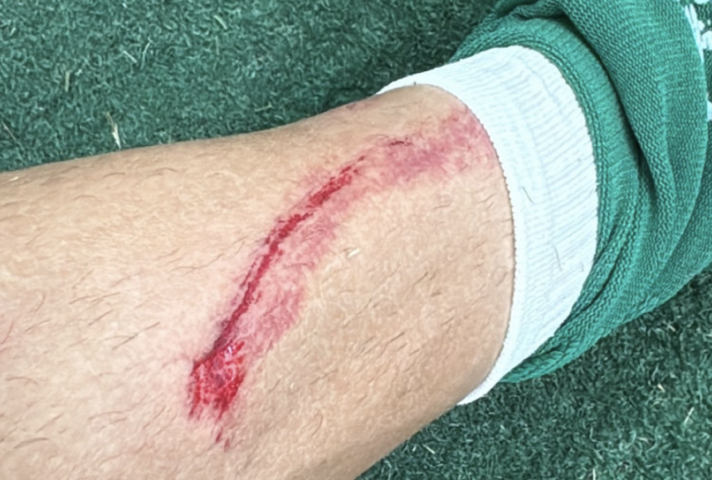 Flaco López posta foto de machucado e Palmeiras reclama de falta de revisão do VAR