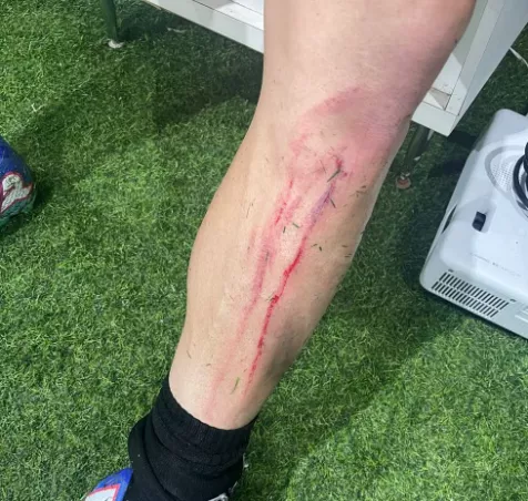 Zagueiro do Athletic mostra corte apos dividida com atacante do Criciuma 1