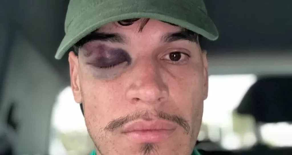 Gustavo Gómez mostra olho roxo após vitória do Palmeiras: ‘Tudo ok’