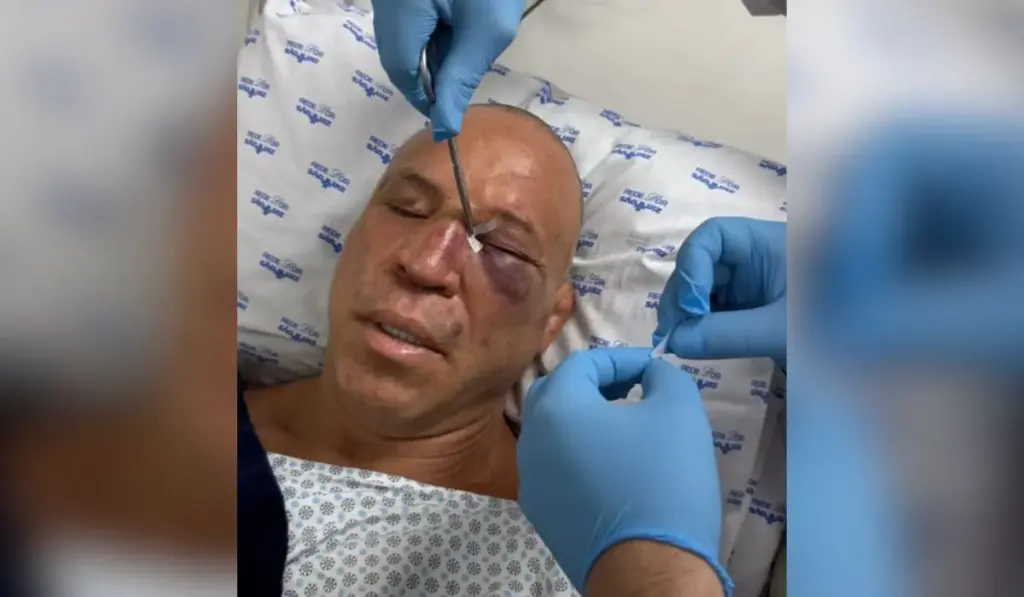 Wanderlei Silva quebra nariz e leva pontos após ‘nocaute’ em confusão
